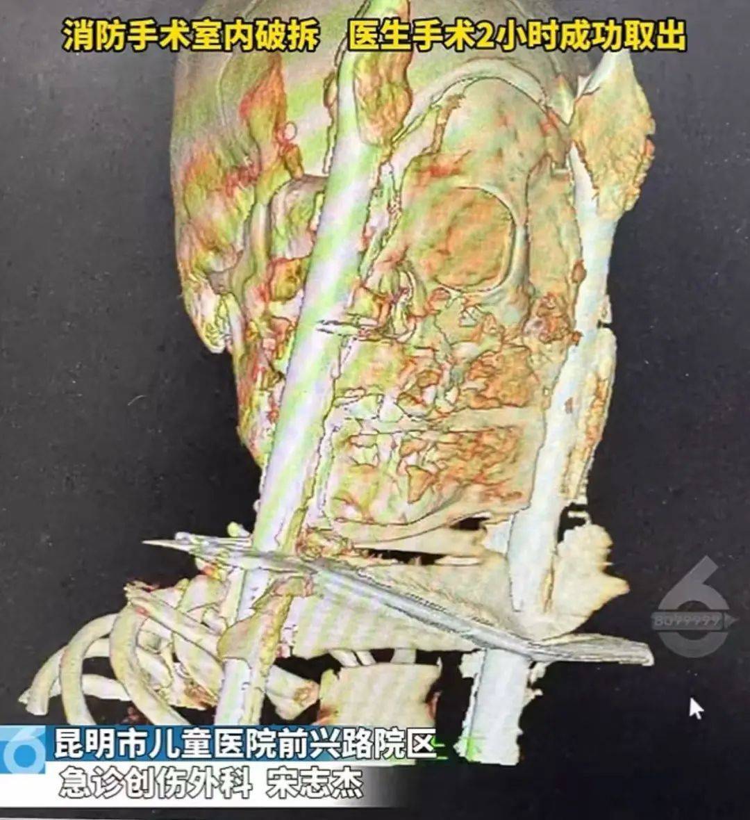 8岁男孩被“长矛”刺穿面部！家长吓坏了